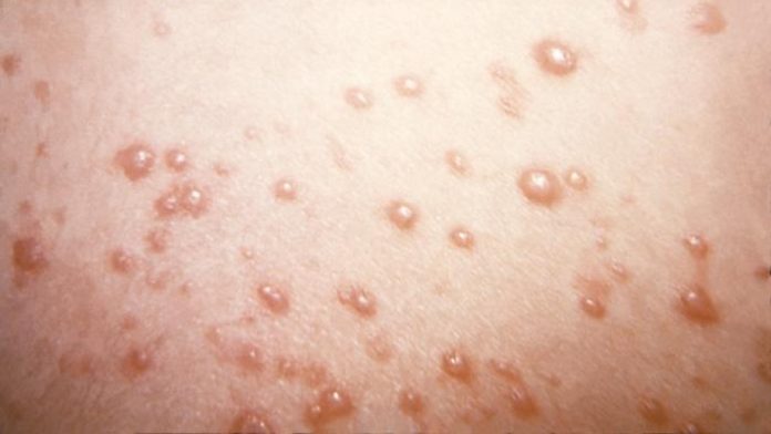 shingles.jpg