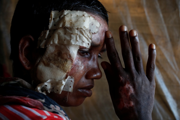 MYANMAR-ROHINGYA/INJURIES
